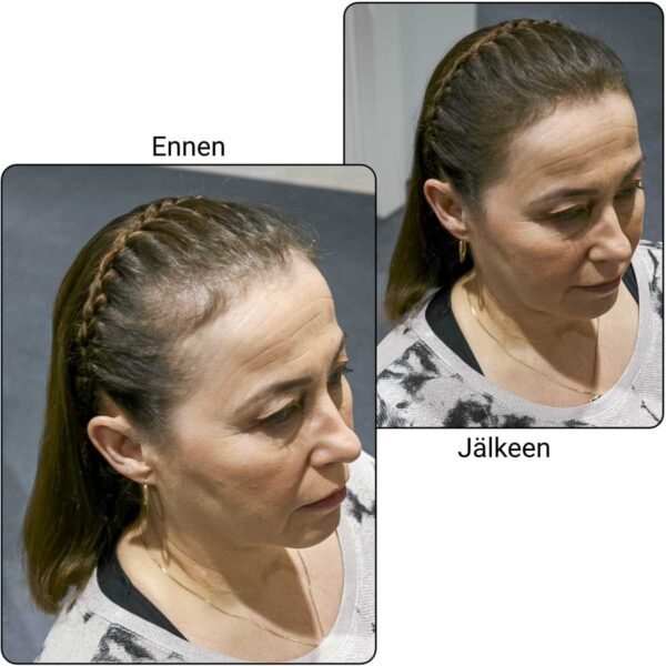 TopFiber otsaraja ennen/jälkeen TopFiber otsaraja ennen/jälkeen