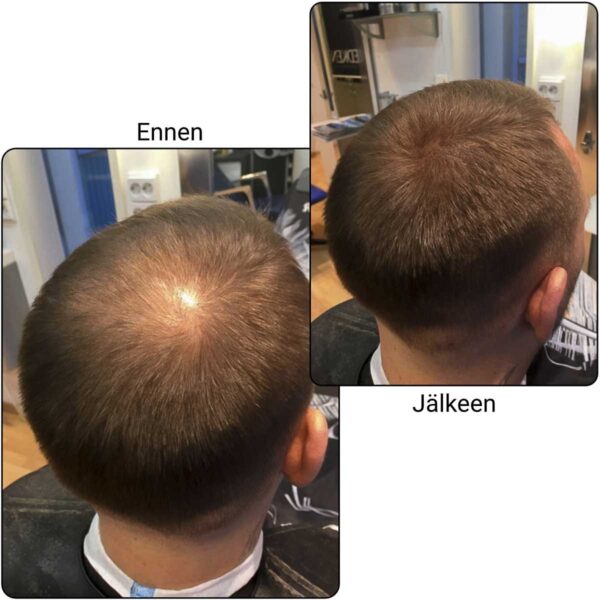 TopFiber takaraivo ennen/jälkeen TopFiber takaraivo ennen/jälkeen